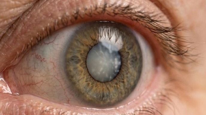 Close up photo of a significant case of cataracts in a man's eye.