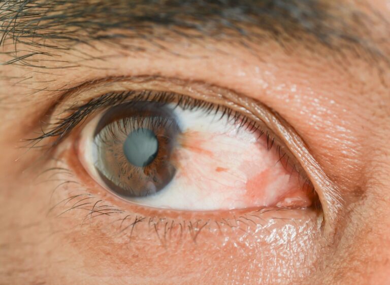 An example of Pteryium eye or surfers eye.